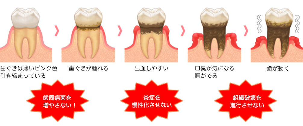 歯周炎の進行