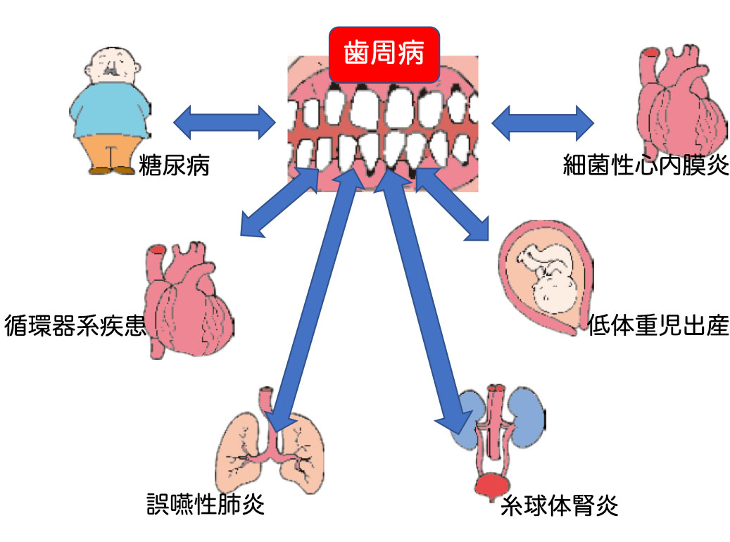 歯周病と全身疾患